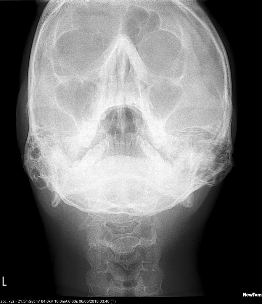 3d Dental X-rays - Dental And Maxillofacial Imaging 